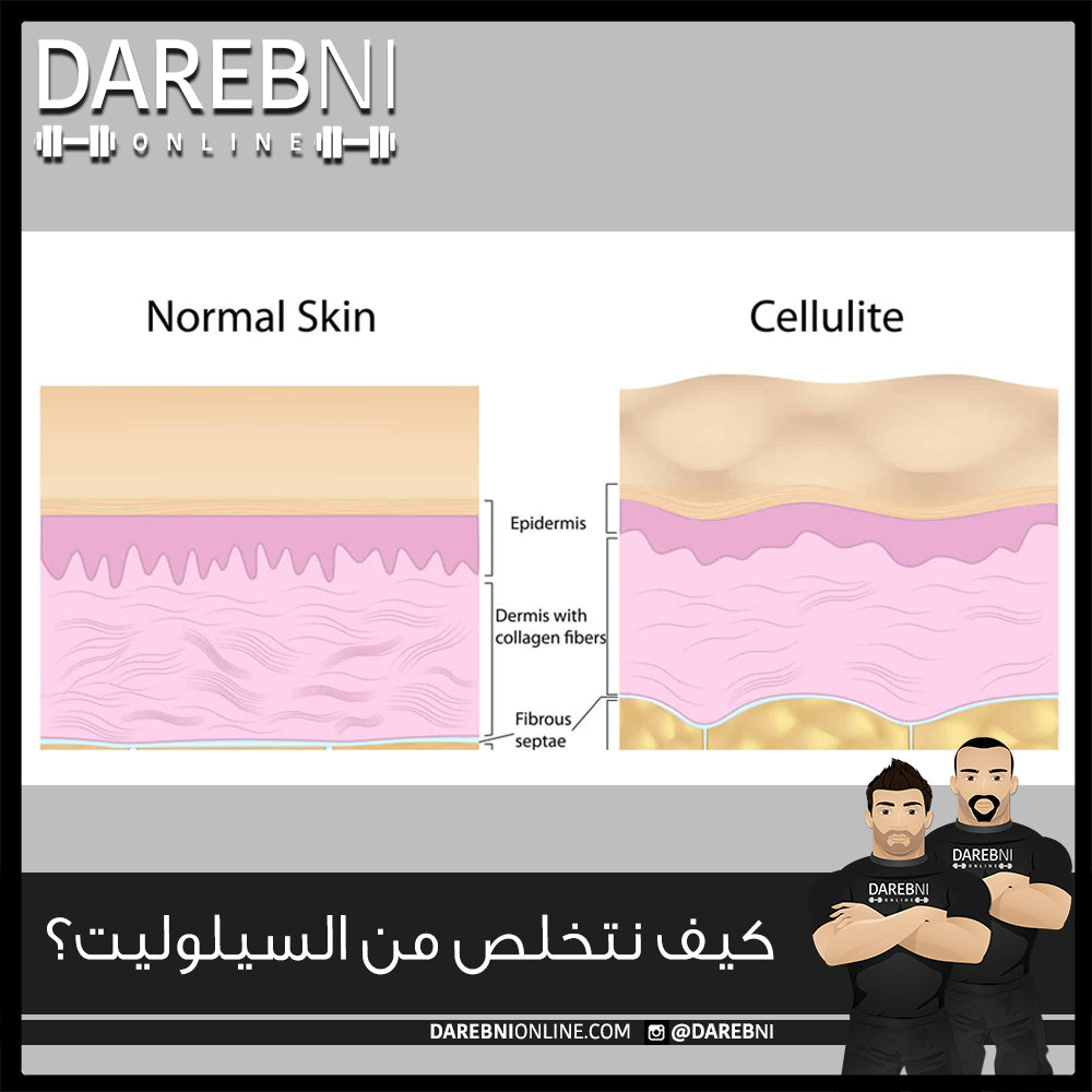 شلون نتجنب السيلوليت؟